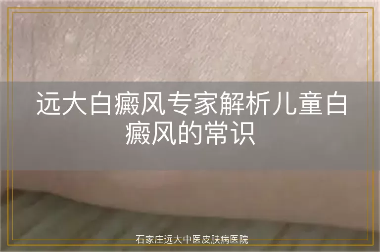远大白癜风专家解析儿童白癜风的常识