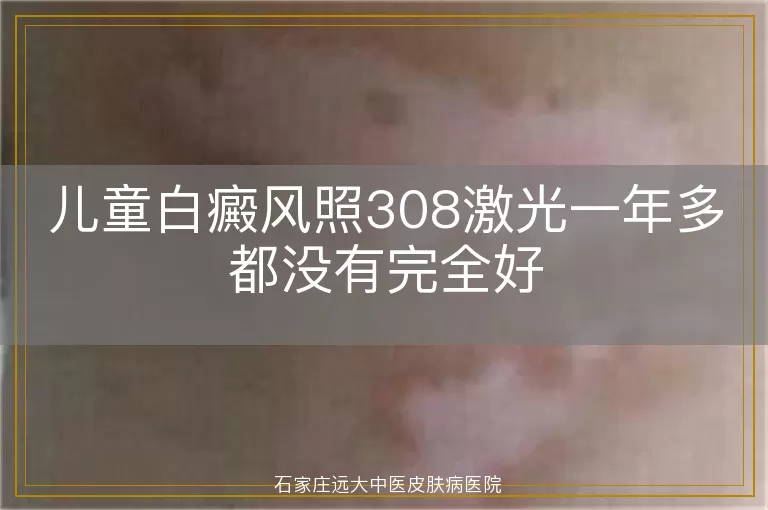 儿童白癜风照308激光一年多都没有完全好