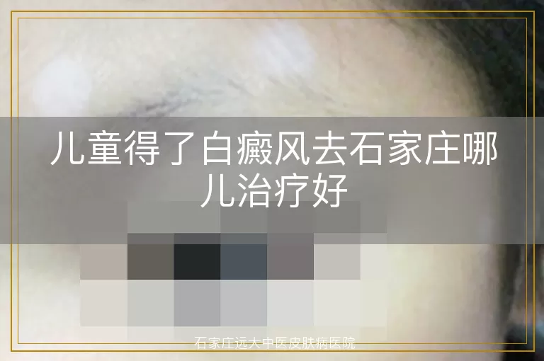 儿童得了白癜风去石家庄哪儿治疗好