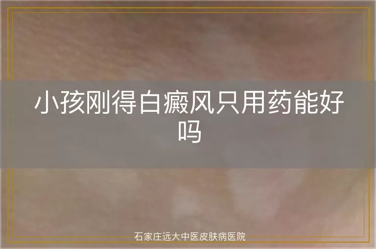 小孩刚得白癜风只用药能好吗