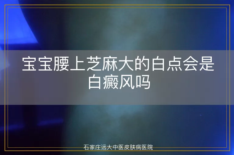 宝宝腰上芝麻大的白点会是白癜风吗