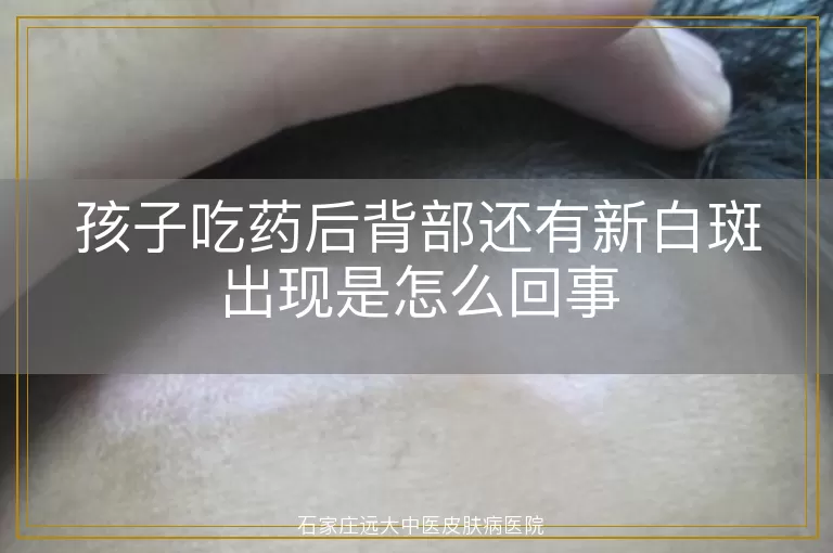 孩子吃药后背部还有新白斑出现是怎么回事