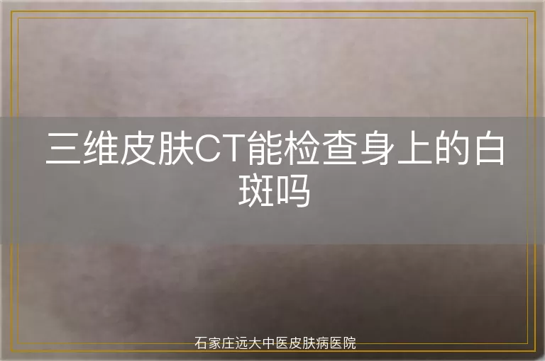 三维皮肤CT能检查身上的白斑吗