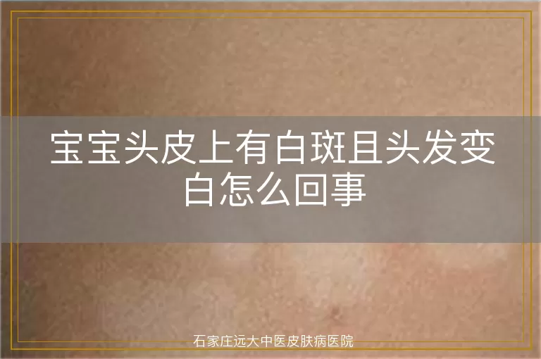 宝宝头皮上有白斑且头发变白怎么回事