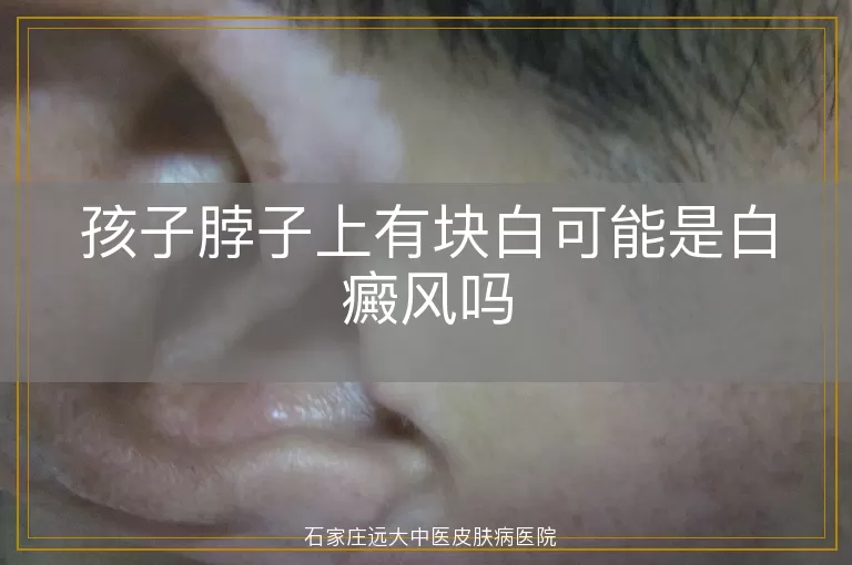 孩子脖子上有块白可能是白癜风吗