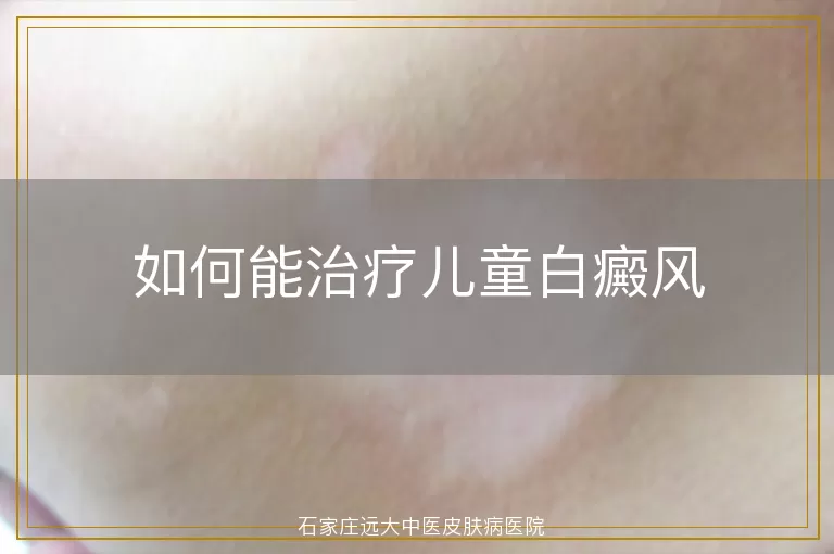 如何能治疗儿童白癜风