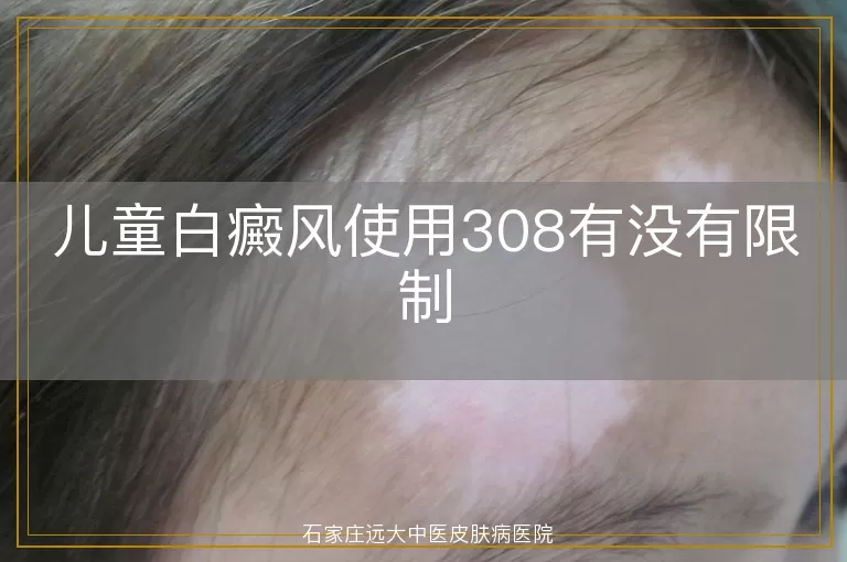 儿童白癜风使用308有没有限制
