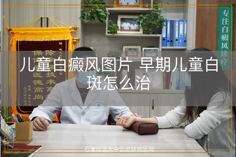 儿童白癜风图片 早期儿童白斑怎么治