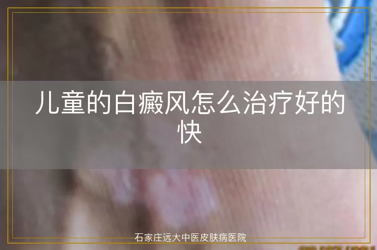 儿童的白癜风怎么治疗好的快