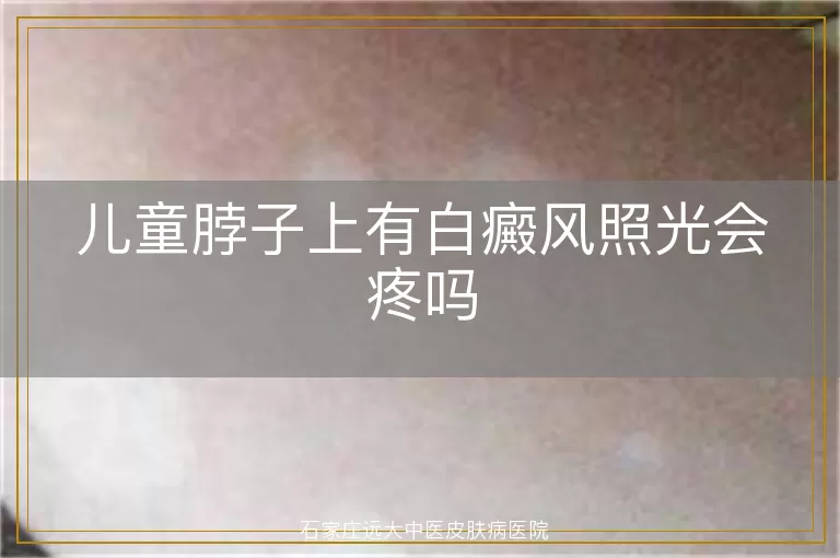 儿童脖子上有白癜风照光会疼吗