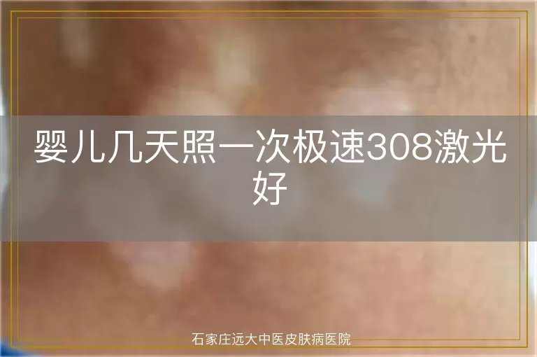 婴儿几天照一次极速308激光好