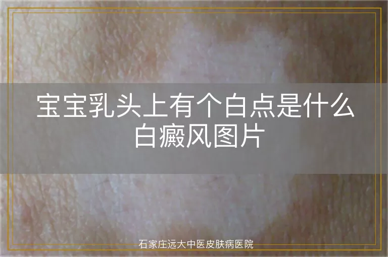 宝宝乳头上有个白点是什么 白癜风图片