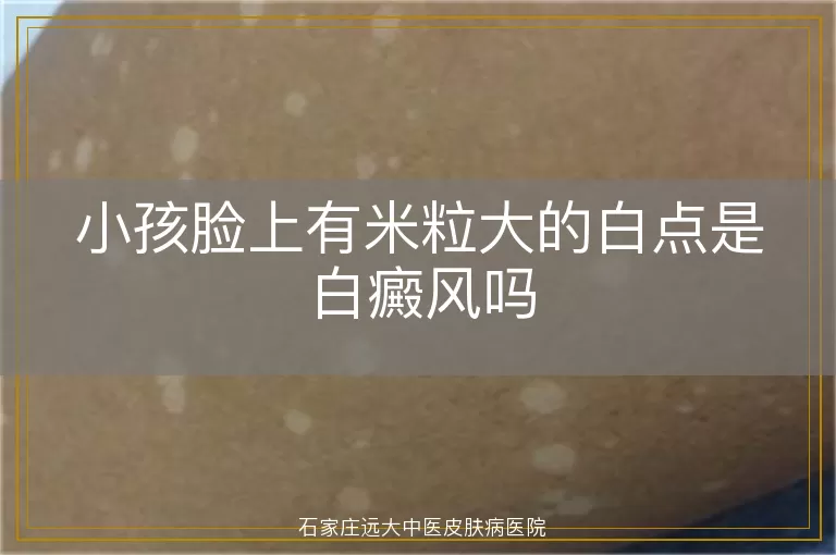 小孩脸上有米粒大的白点是白癜风吗