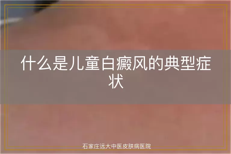 什么是儿童白癜风的典型症状