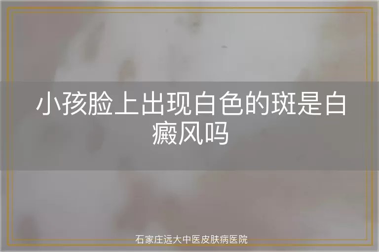 小孩脸上出现白色的斑是白癜风吗