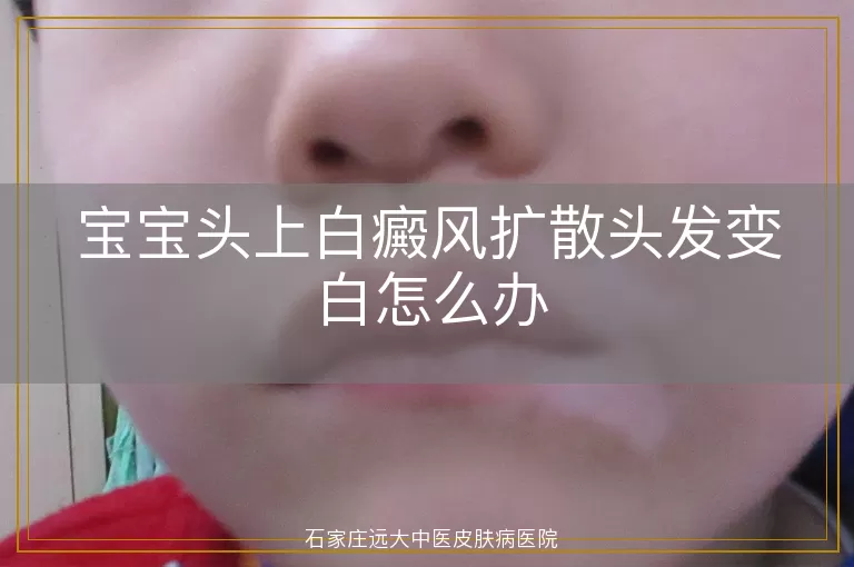 宝宝头上白癜风扩散头发变白怎么办