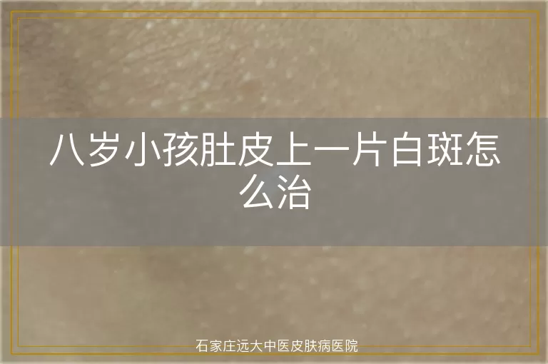 八岁小孩肚皮上一片白斑怎么治