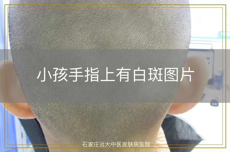小孩手指上有白斑图片