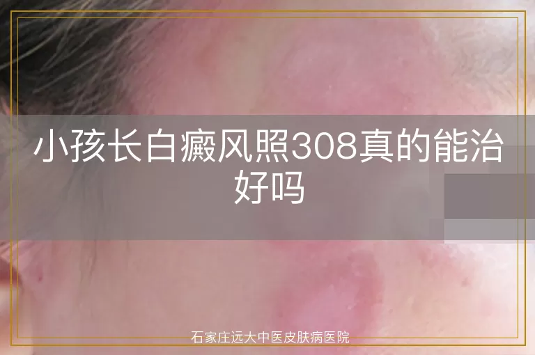 小孩长白癜风照308真的能治好吗