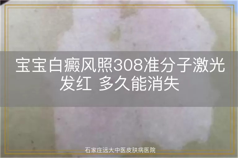 宝宝白癜风照308准分子激光发红 多久能消失