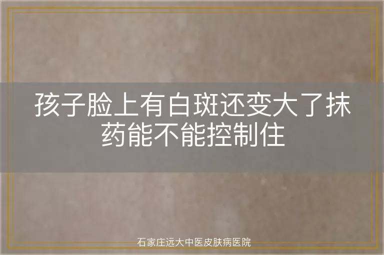 孩子脸上有白斑还变大了抹药能不能控制住