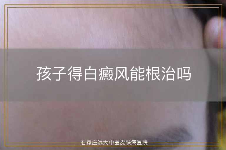 孩子得白癜风能根治吗