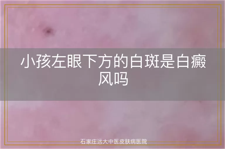 小孩左眼下方的白斑是白癜风吗