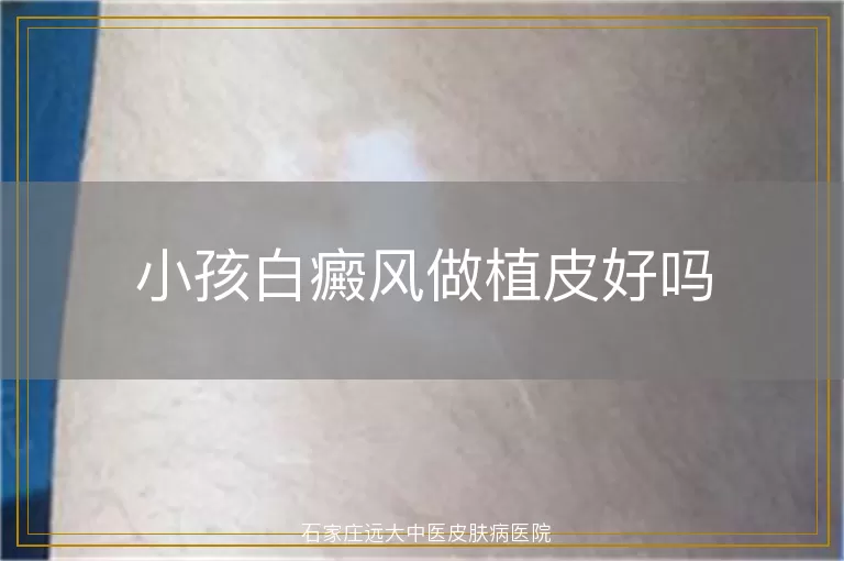 小孩白癜风做植皮好吗