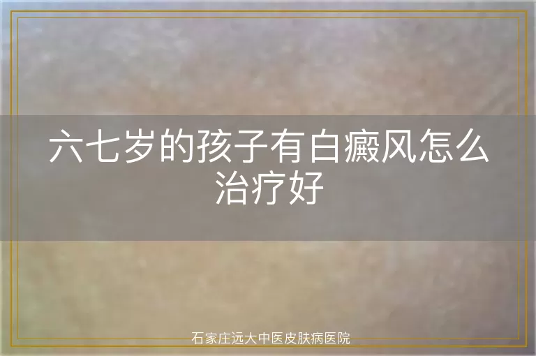 六七岁的孩子有白癜风怎么治疗好