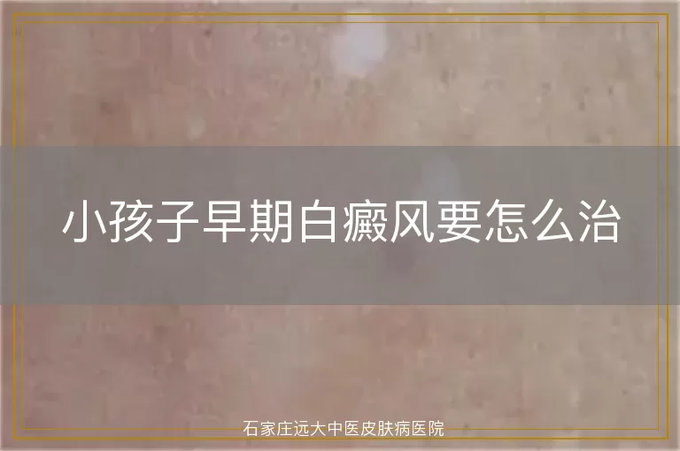 小孩子早期白癜风要怎么治
