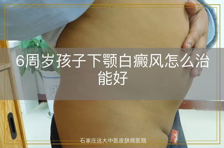 6周岁孩子下颚白癜风怎么治能好