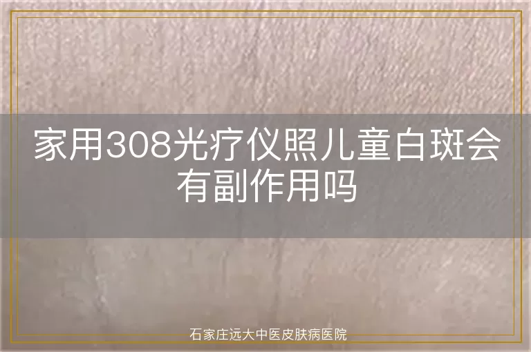 家用308光疗仪照儿童白斑会有副作用吗
