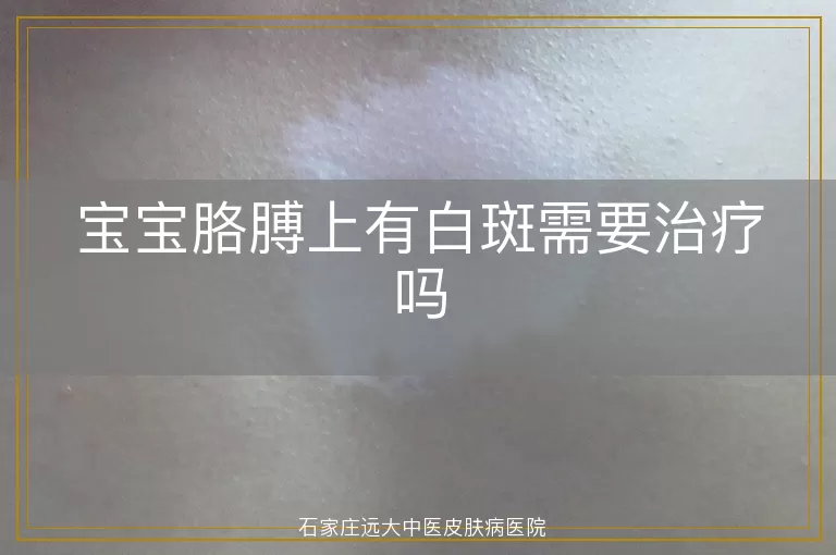 宝宝胳膊上有白斑需要治疗吗