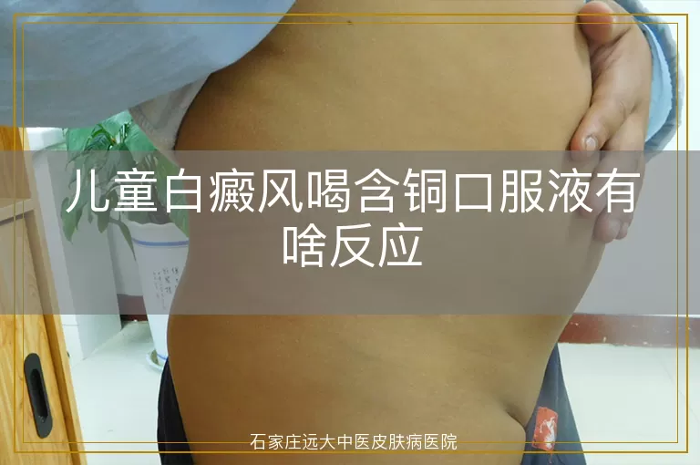 儿童白癜风喝含铜口服液有啥反应