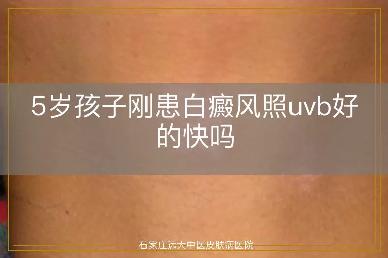 5岁孩子刚患白癜风照uvb好的快吗