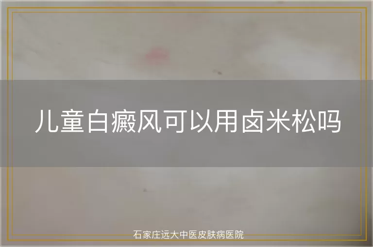 儿童白癜风可以用卤米松吗