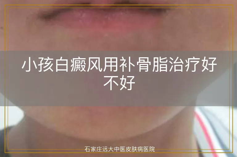 小孩白癜风用补骨脂治疗好不好
