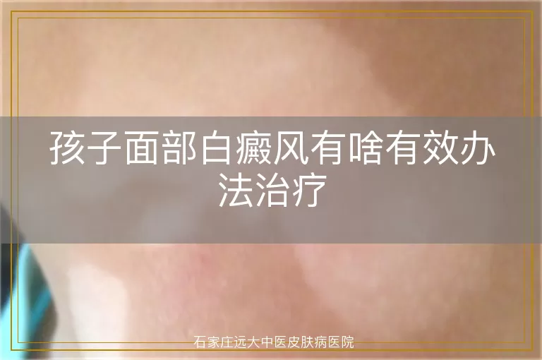 孩子面部白癜风有啥有效办法治疗