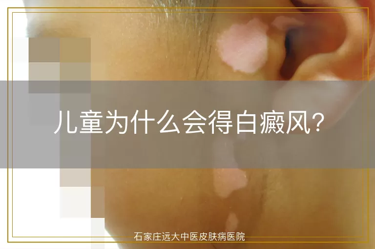 儿童为什么会得白癜风?