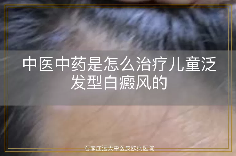 中医中药是怎么治疗儿童泛发型白癜风的