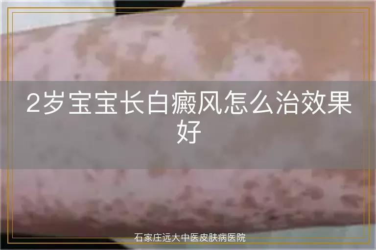 2岁宝宝长白癜风怎么治效果好