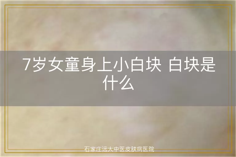 7岁女童身上小白块 白块是什么