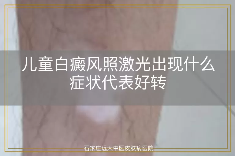 儿童白癜风照激光出现什么症状代表好转
