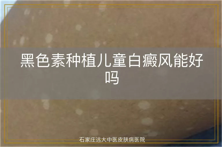 黑色素种植儿童白癜风能好吗