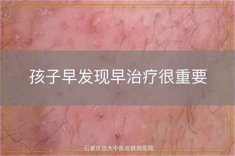 孩子早发现早治疗很重要