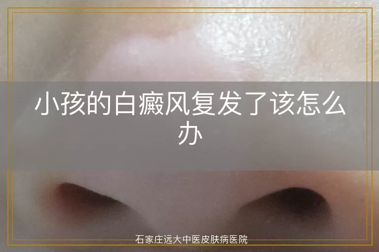 小孩的白癜风复发了该怎么办