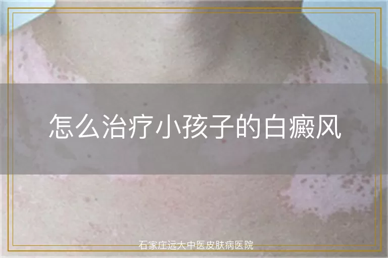 怎么治疗小孩子的白癜风