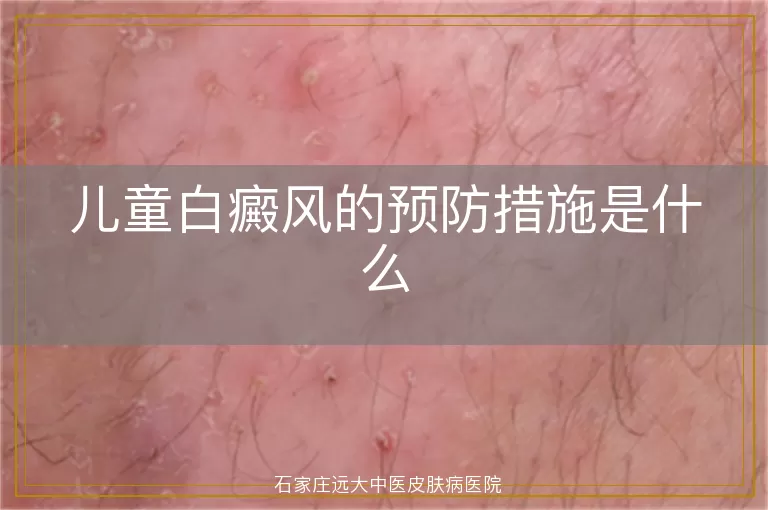 儿童白癜风的预防措施是什么