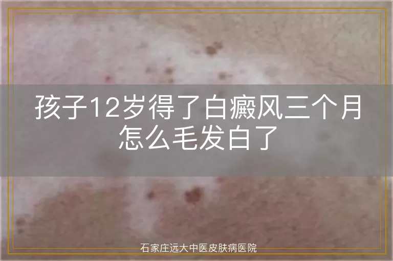 孩子12岁得了白癜风三个月怎么毛发白了