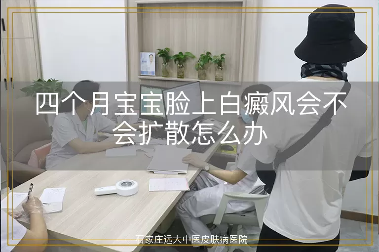 四个月宝宝脸上白癜风会不会扩散怎么办